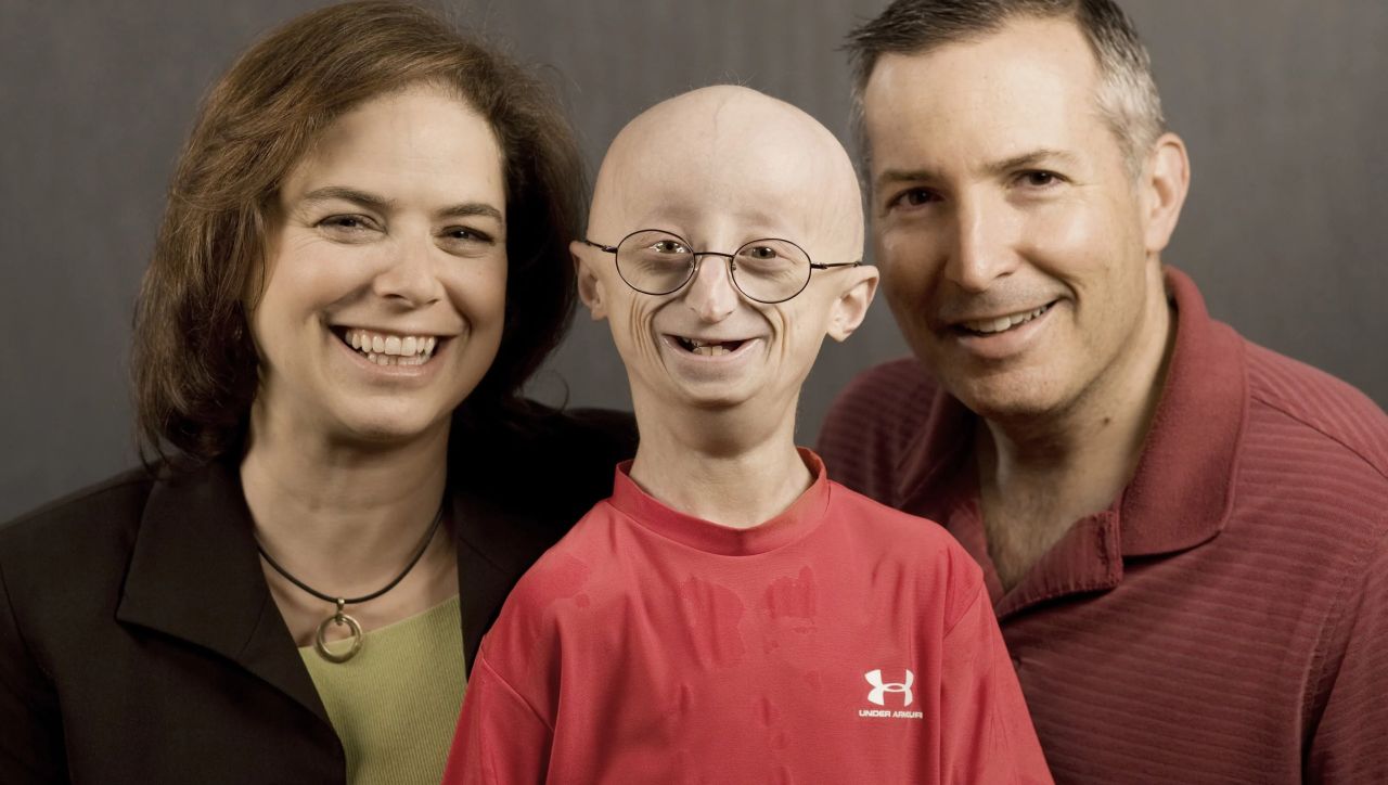 Progeria Sendromu Nedir?